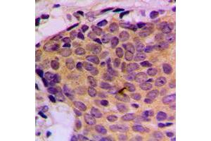 Immunohistochemical analysis of STAT5 staining in human breast cancer formalin fixed paraffin embedded tissue section. (STAT5A anticorps  (C-Term))