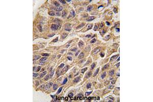 Formalin-fixed and paraffin-embedded human lung carcinomareacted with IDO1 polyclonal antibody , which was peroxidase-conjugated to the secondary antibody, followed by AEC staining. (IDO1 anticorps  (C-Term))