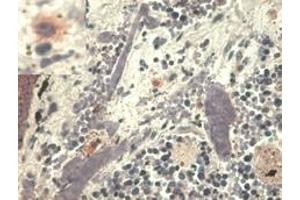 Immunohistochemistry staining with anti-human HLA-G (MEM-G/1) - pulmonary disseases (paraffin-embedded sections).