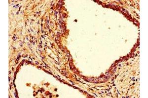 Immunohistochemistry of paraffin-embedded human prostate cancer using ABIN7148014 at dilution of 1:100 (COPE anticorps  (AA 2-308))
