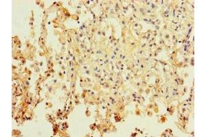Immunohistochemistry of paraffin-embedded human lung cancer using ABIN7162702 at dilution of 1:100 (PAXIP1 anticorps  (AA 613-812))