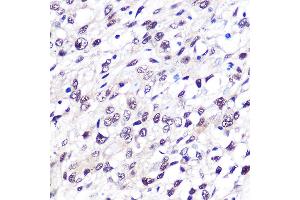 Immunohistochemistry of paraffin-embedded human bladder cancer using FTO Rabbit mAb (ABIN1679842, ABIN3018203, ABIN3018204 and ABIN7101583) at dilution of 1:100 (40x lens). (FTO anticorps)