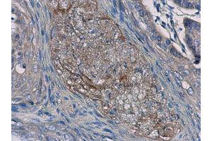 IHC-P Image Interleukin-24 antibody [C2C3], C-term detects Interleukin-24 protein at cytoplasm in human esophageal cancer by immunohistochemical analysis. (IL-24 anticorps  (C-Term))