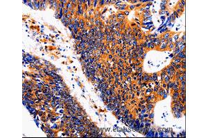 Immunohistochemistry of Human colon cancer using IL18BP Polyclonal Antibody at dilution of 1:50 (IL18BP anticorps)