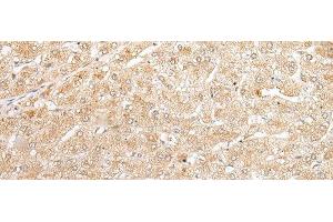 Immunohistochemistry of paraffin-embedded Human liver cancer tissue using NUDT19 Polyclonal Antibody at dilution of 1:25(x200) (NUDT19 anticorps)