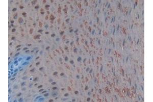 Detection of S100A8 in Human Esophagus cancer Tissue using Polyclonal Antibody to S100 Calcium Binding Protein A8 (S100A8)