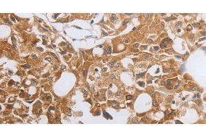 Immunohistochemistry of paraffin-embedded Human lung cancer using MUC20 Polyclonal Antibody at dilution of 1:40 (MUC20 anticorps)