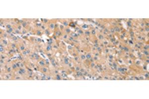 Immunohistochemistry of paraffin-embedded Human liver cancer tissue using STK16 Polyclonal Antibody at dilution of 1:30(x200)