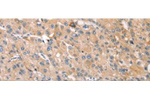 Immunohistochemistry of paraffin-embedded Human liver cancer tissue using STK16 Polyclonal Antibody at dilution of 1:30(x200) (STK16 anticorps)
