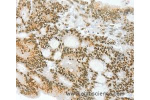 Immunohistochemistry of Human colon cancer using ANGPT4 Polyclonal Antibody at dilution of 1:70 (Angiopoietin 4 anticorps)
