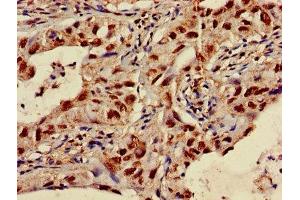 Immunohistochemistry of paraffin-embedded human lung cancer using ABIN7170231 at dilution of 1:100 (SLC35F2 anticorps  (AA 335-374))