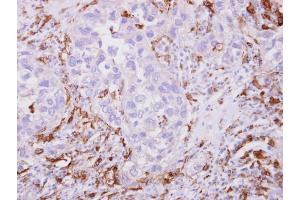IHC-P Image Iba1 antibody detects Iba1 protein at cytoplasm on human breast cancer stroma by immunohistochemical analysis. (Iba1 anticorps)