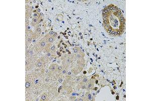 Immunohistochemistry of paraffin-embedded human liver injury using KTN1 antibody (ABIN5973485) at dilution of 1/100 (40x lens). (KTN1 anticorps)