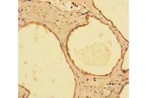 Immunohistochemistry of paraffin-embedded human prostate cancer using ABIN7156292 at dilution of 1:100 (IMPDH2 anticorps  (AA 5-514))