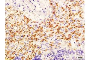 Formalin-fixed and paraffin embedded mouse tumor with labeled Anti-phospho-AKT/PKB(Ser473) Polyclonal Antibody, Unconjugated  at 1:600, followed by conjugation to the secondary antibody and DAB staining (AKT 1/2/3 anticorps  (pSer473))