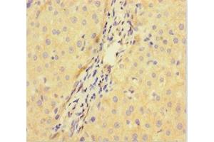 Immunohistochemistry of paraffin-embedded human liver cancer using ABIN7149517 at dilution of 1:100 (DDB1 and CUL4-Associated Factor 1 (DCAF1) (AA 647-745) anticorps)