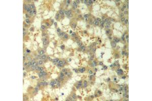 Immunohistochemistry of paraffin-embedded human breast carcinoma using Phospho-SYK-Y323 antibody (ABIN2987845). (SYK anticorps  (pTyr323))