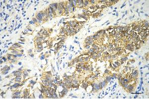 Immunohistochemistry was performed on paraffin-embedded human sigmoid colon carcinoma using catenin beta 1 antibody (ABIN7797926), 1:200).