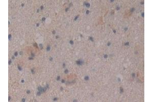 Detection of CD109 in Human Glioma Tissue using Polyclonal Antibody to Cluster Of Differentiation 109 (CD109) (CD109 anticorps  (AA 1146-1390))