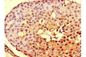 Immunohistochemistry of paraffin-embedded human breast cancer using ABIN7161302 at dilution of 1:100