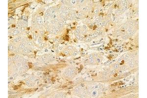 ABIN6266048 and ABIN6278957 at 1/100 staining human esophageal carcinoma by IHC-P.