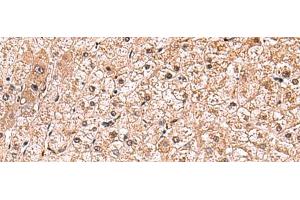 Immunohistochemistry of paraffin-embedded Human liver cancer tissue using RUSC1 Polyclonal Antibody at dilution of 1:90(x200) (RUSC1 anticorps)