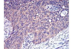 Immunohistochemical analysis of paraffin-embedded cervical cancer tissues using CFHR5 mouse mAb with DAB staining.