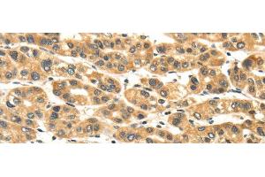 Immunohistochemistry of paraffin-embedded Human liver cancer tissue using NME8 Polyclonal Antibody at dilution 1:45 (TXNDC3/NME8 anticorps)