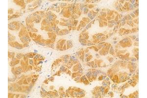 ABIN6256882 and ABIN6274575 at 1/100 staining human renal cell carcinoma by IHC-P. (Serotonin Receptor 4 anticorps  (C-Term))