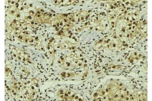 ABIN6267079 at 1/100 staining Human breast cancer tissue by IHC-P. (AC-FKHR anticorps)