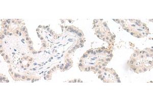 Immunohistochemistry of paraffin-embedded Human thyroid cancer tissue using GHDC Polyclonal Antibody at dilution of 1:90(x200) (GHDC anticorps)