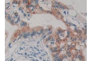 Detection of TMPRSS4 in Human Bile duct cancer Tissue using Polyclonal Antibody to Transmembrane Protease, Serine 4 (TMPRSS4)