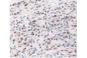 IHC-P analysis of Human Stomach Cancer Tissue, with DAB staining. (TNF alpha anticorps  (AA 77-233))