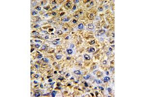 Formalin-fixed and paraffin-embedded human hepatocarcinoma with DCN Antibody (Center), which was peroxidase-conjugated to the secondary antibody, followed by DAB staining. (Decorin anticorps  (AA 122-150))