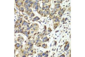 Immunohistochemistry of paraffin-embedded human esophageal cancer using SLC25A4 antibody.