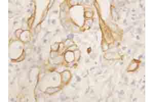 Immunohistochemical staining of TNFRSF1B on formalin fixed, paraffin embedded human intestinal cancer with TNFRSF1B polyclonal antibody .