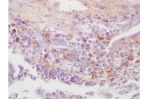 Formalin-fixed and paraffin embedded human lung carcinoma labeled with Rabbit Anti-IRAK4(Thr345) Polyclonal Antibody, Unconjugated (ABIN2177052) at 1:200 followed by conjugation to the secondary antibody and DAB staining (IRAK4 anticorps  (pThr345))