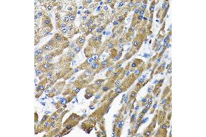Immunohistochemistry of paraffin-embedded human liver cancer using THUMPD3 Rabbit pAb (ABIN6132951, ABIN6149133, ABIN6149134 and ABIN6214652) at dilution of 1:200 (40x lens).