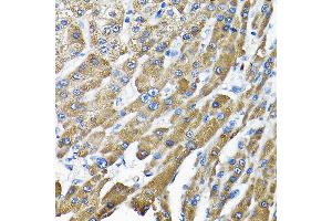 Immunohistochemistry of paraffin-embedded human liver cancer using THUMPD3 Rabbit pAb (ABIN6132951, ABIN6149133, ABIN6149134 and ABIN6214652) at dilution of 1:200 (40x lens). (THUMPD3 anticorps  (AA 1-250))