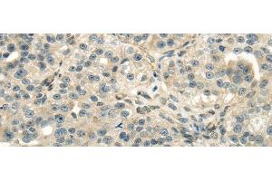 Immunohistochemistry of paraffin-embedded Human breast cancer using DLAT Polyclonal Antibody at dilution of 1/40