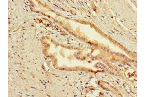 Immunohistochemistry of paraffin-embedded human prostata cancer using ABIN7159849 at dilution of 1:100 (Slc25a1 anticorps  (AA 124-162))