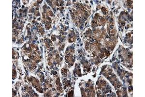 Immunohistochemical staining of paraffin-embedded Carcinoma of liver tissue using anti-SATB1mouse monoclonal antibody. (SATB1 anticorps)