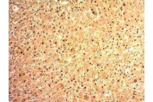 Formalin-fixed, paraffin-embedded human hepatocellular carcinoma stained with Arginase 1 antibody (ARG1/1125).