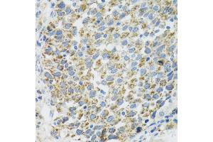 Immunohistochemistry of paraffin-embedded human lung cancer using TXN2 antibody. (TXN2 anticorps)
