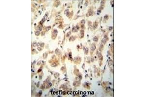 TTC16 antibody (N-term) (ABIN654516 and ABIN2844240) immunohistochemistry analysis in formalin fixed and paraffin embedded human testis carcinoma followed by peroxidase conjugation of the secondary antibody and DAB staining. (TTC16 anticorps  (N-Term))