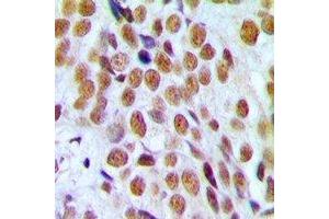 Immunohistochemical analysis of Progesterone Receptor staining in human breast cancer formalin fixed paraffin embedded tissue section.