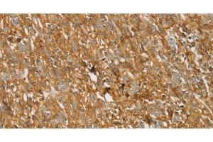 Immunohistochemistry of paraffin-embedded Human gastric cancer using TMPRSS11F Polyclonal Antibody at dilution of 1:30 (TMPRSS11F anticorps)