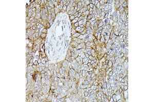 Immunohistochemistry of paraffin-embedded human oophoroma using β-Catenin antibody (ABIN7266137) at dilution of 1:100 (40x lens).