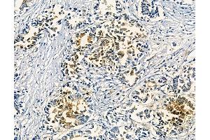 ABIN6258958 and ABIN6275208 at 1/100 staining human pancreatic cancer by IHC-P.