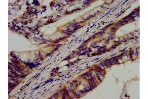 IHC image of ABIN7146245 diluted at 1:600 and staining in paraffin-embedded human colon cancer performed on a Leica BondTM system.